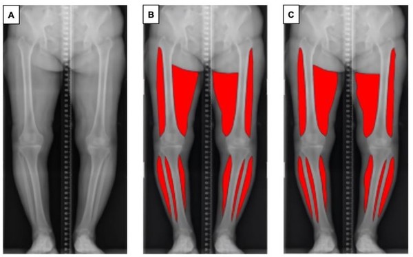 (A)원본 방사선 이미지 (B)전문의가 표시한 분절된 근육 (C)인공지능 모델이 예측한 분절된 근육