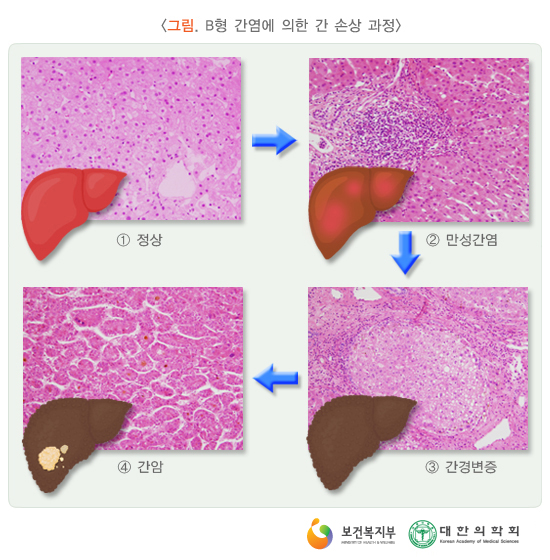 간염 바이러스 상태에 대한 기본 상식