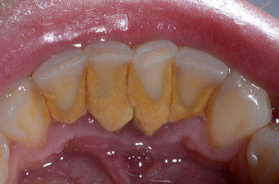 스케일링이 시린 걱정이라면? 3