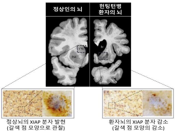 정상뇌의 XIAP 분자 발현(왼쪽)과 환자뇌 XIAP 분자 감소(오른쪽)