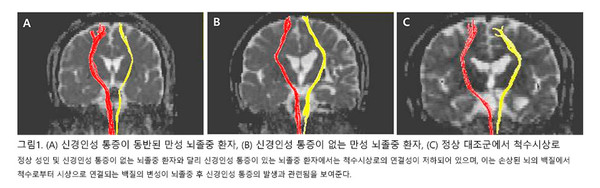  신경인성 통증이 있는 만성 뇌졸중 환자 A의 뇌백질 변화
