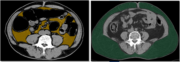 체질량지수는 24.2kg/m2, 24.4kg/m2 로 비슷하나 내장지방(노란색)과 피하지방(초록색)의 비율이 각각 2.5, 0.7 로 다른 두 복부 CT 모습. 내장지방 비율이 높은 좌측이 심혈관 석회화가 더 심하게 진행