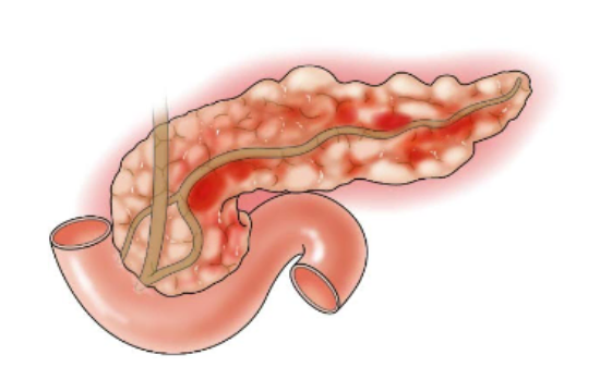 급성췌장염: 췌장과 췌장주변의 부종과 염증이 심함