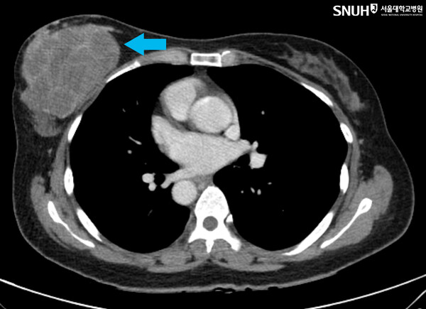 악성 엽상종 환자의 CT 사진. 사진=서울대병원 제공