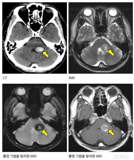 출혈을 동반한 해면상혈관종의 영상검사. 출처=네이버 서울대병원 의학정보 제공