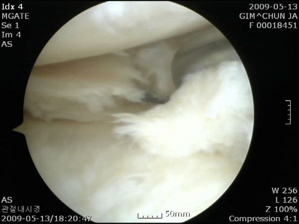 관절내시경으로 살펴본 ‘내측 반월상연골판 파열’ 모습