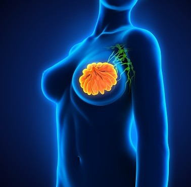 유방암 초기 증상은 무증상이지만, 조기 발견할 수 있는 방법이 없는 것은 아니다. 매달 생리가 끝나고 1주일 뒤, 자가유방검사만 해도 유방암을 조기 발견할 수 있는 길이 있다. 그래픽=게티이미지 제공