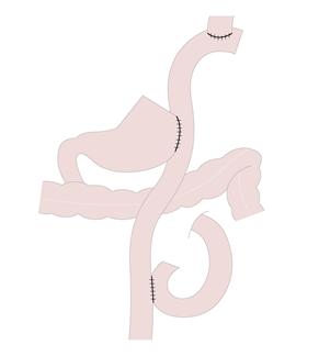 근위부 위절제 후 이중통로문합술 모습. 그래픽=서울대병원 제공