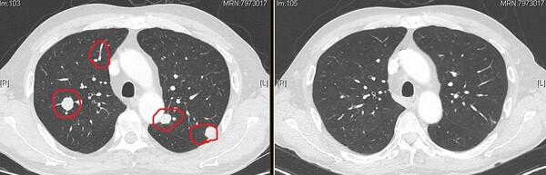 원주세브란스기독병원 신장암 환자 A씨의 치료 전후 CT 사진 변화. 왼쪽 사진의 동그라미가 돼 있는 부분이 오른쪽 사진에서는 보이지 않는다. 