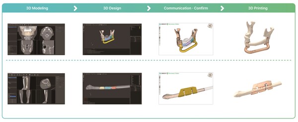 3D 프린팅 기술을 이용해 가이던스를 제작하는 과정. 그래픽 제공=강북삼성병원