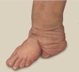 발과 다리에 생긴 신경섬유종증. 사진 출처=서울아산병원