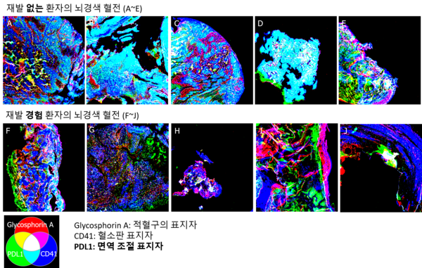 재발군 혈전(F~J)에서는 대조군(A~E)에 비해 PDL1 발현이 감소했다. 그래픽 제공=서울대병원
