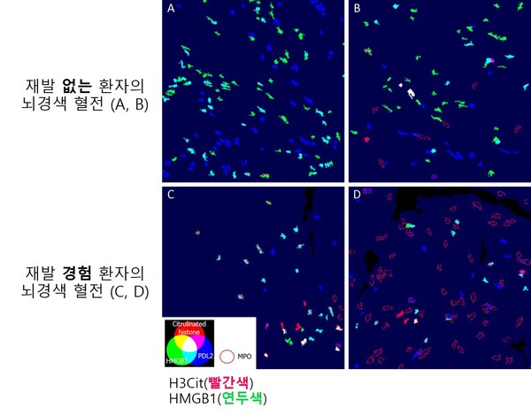 재발군의 혈전(C,D)에서는 대조군(A,B)에 비해 HMGB1 발현이 적고, H3Cit 발현이 증가했다. 그래픽 제공=서울대병원