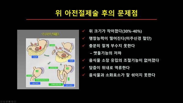 위를 3분의 2 절제하는 '위 아전절제술' 후의 우리 몸의 변화