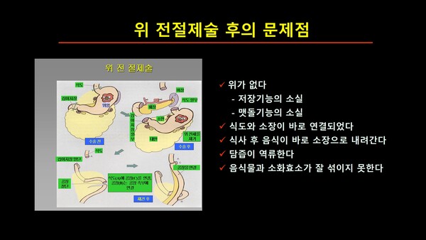 위 전절제술 후 우리 몸의 변화