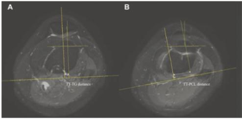 A. 경골결절과 활차구 사이(TT-TG) 거리_슬개건이 닿는 부위의 중심을 지나는 직선과 활차구 홈의 가장 깊숙한 부분을 지나는 직선 사이의 거리B. 경골결절과 후방십자인대 사이(TT-PCL) 거리_슬개건이 닿는 부위의 중심을 지나는 직선과 후방십자인대의 안쪽 모서리를 지나는 직선 사이의 거리