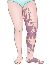 클리펠-트라우네이-베버 증후군에 특징적인 화염성 모반. 그림 제공=서울아산병원