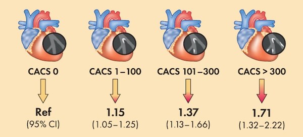 관상동맥에 동맥경화가 진행되면서 혈관이 딱딱하게 굳어지는 '관상동맥 석회화'가 심할수록 만성콩팥병 발생 위험도가 증가했다. 그래픽 제공=강북삼성병원