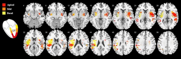 좌심실을 세 부위로 나누어 분석했을 때 좌심실 움직임 변화에 이상이 생긴 곳에 따라 뇌의 손상 영역도 조금씩 달랐던 것을 확인할 수 있다. 해당 영역에 뇌졸중이 발생하면 좌심실의 각 부위도 영향을 받는다는 의미다. 빨간색(정점), 주황색, 노란색(기저부)으로 구분. 이미지 제공=삼성서울병원