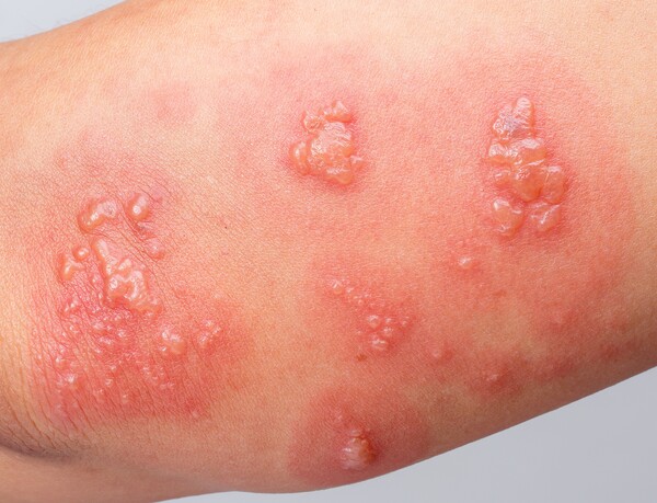 노란 고름의 물집이 잡히는 것은 전신농포건선의 급성 악화 신호탄이다. 사진 제공=게티이미지