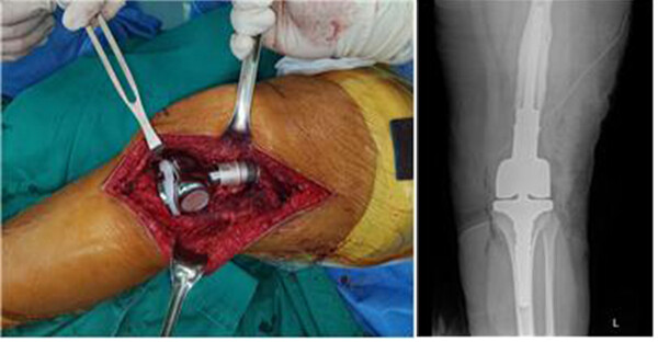 무릎을 구성하는 대퇴골의 하단부와 경골의 상단을 모두 제거한 후 인공대체물을 넣은 수술 소견과 수술 후 X-ray 사진이다. 