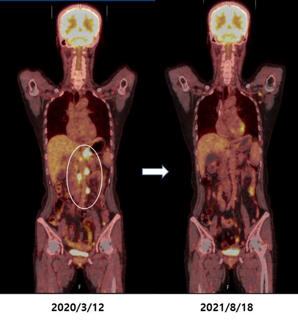 대동맥 림프절 전이 환자의 항암치료 전후 PET-CT. 자료 제공=서울성모병원