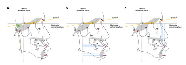 측모 두부계측방사선 사진(Lateral cephalogram)의 랜드마크와 길이, 각도 변수들