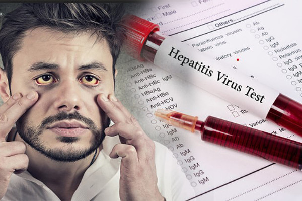 B형간염 치료 개시 기준을 '바이러스 수치’로 딘순화한 뒤 건강보험 급여 기준에 반영하면 1년에 약 3,000명의 간암 발생을 예방할 수 있다는 연구결과가 발표돼 관심이 집중된다. 이미지 출처=게티이미지