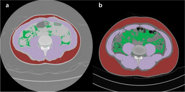 생물학적 제제 사용 전(a)·후(b) 환자의 복부 CT 사진. 내장지방(초록색) 피하지방(빨간색)이 많이 늘어난 것을 확인 / 논문발췌