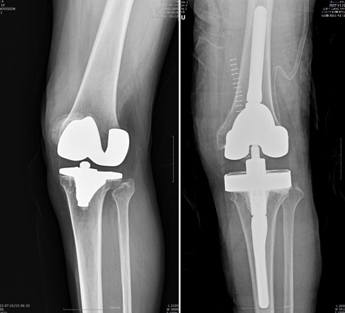 인공관절 재치환술 전 후 외상으로 인해 축이 비뚤어졌던 무릎이 바로 잡혔다