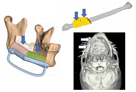 디지털 프로그램과 3D 프린팅 기술을 이용해 광범위한 구강암 수술 후 턱뼈를 정교하게 재건했다. 이미지 제공=서울대병원