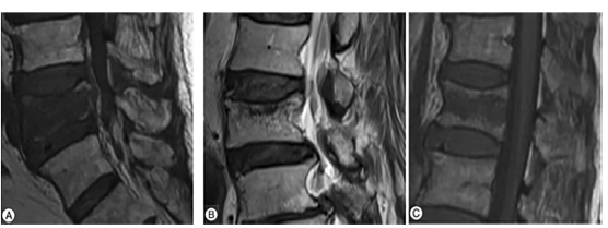골다공증성 척추 골절 환자의 MRI 사진. A.확산형 타입, B.종판 타입 C. 중심부 타입 / 서울성모병원 