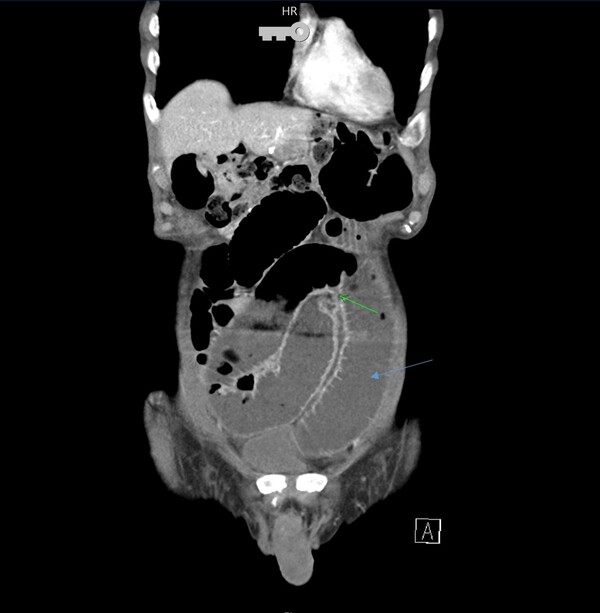 위암수술을 받은 장폐색증 환자의 CT 사진. 하늘색 화살표 부위가 폐색 상부의 장으로 부풀어 있고 초록색 화살표 부위가 좁아진 부위이다. 이미지 제공=서울성모병원