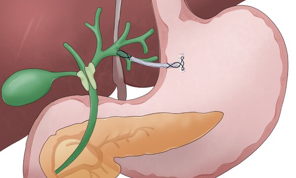 새 금속 배액관이 간내 담도와 위를 연결해 담도 배액을 시행하는 모식도. 그래픽 제공=순천향대부천병원