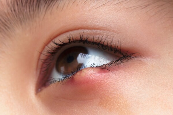 치료를 계속 해도 다래끼가 낫지 않는다면 의심해봐야 하는 질환이 있다. 바로 희귀암으로 분류되는 '안암'이 그것이다. 사진 출처=게티이미지