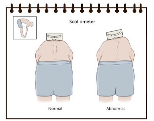 전방굴곡검사. 무릎을 편 상태에서 몸을 앞으로 구부리면 한쪽 등이나 허리가 튀어나온 것이 드러난다.