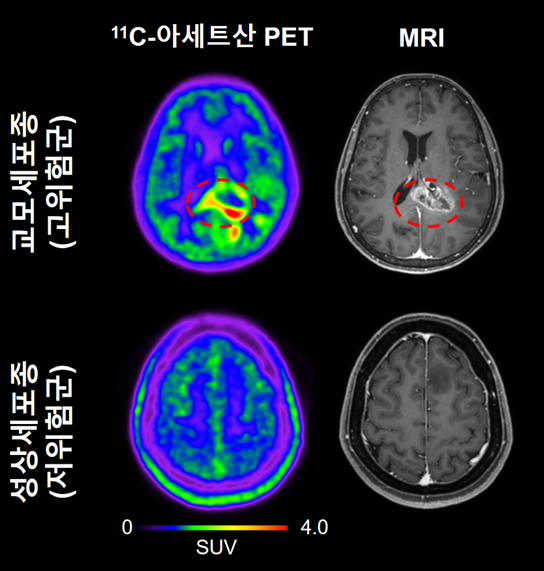 교모세포종(고위험군) 환자와 성상세포종(저위험군) 환자에서 관찰되는 11C-아세트산 PET와 MRI 이미지 / IBS
