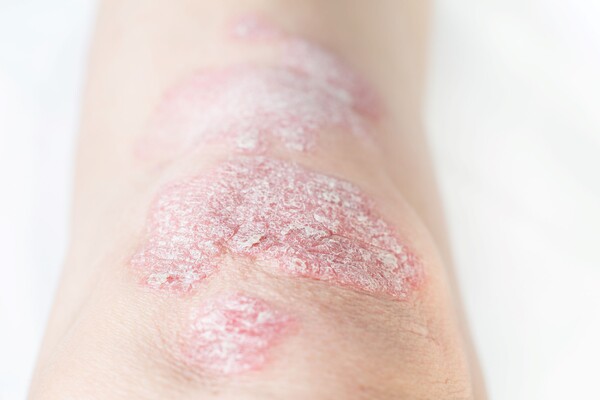 건선. 사진 출처=게티이미지