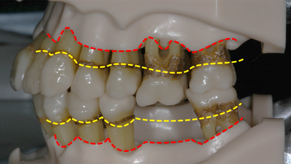 치석 위의 세균에 의해 잇몸뼈가 녹아 내려앉은 모습. 사진 제공=서울대치과병원
