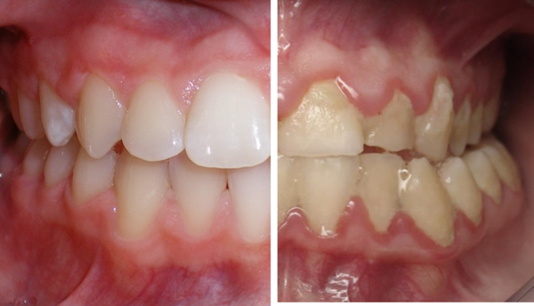 깨끗하고 건강한 입안(좌)과 치태/플라그가 많이 쌓인 입안(우) 모습. 사진 제공=서울대치과병원