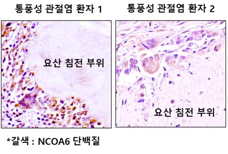 통풍성 관절염 환자의 병변부위에 핵수용체 활성보조인자 6(Nuclear receptor coactivator, NCOA6)의 발현이 증가되어 있음.