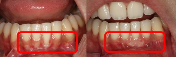 잇몸이식술을 통해 노출된 치근면을 덮기 전(왼쪽)과 치료 후 모습(오른쪽). 사진 제공=서울대치과병원