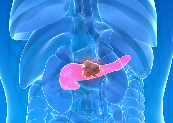 췌장에 생긴 물주머니 '낭종'은 가성 낭종, 장액성 낭종, 점액성 낭종 등이 있는데, 이 가운데 췌장암으로 발전하는 낭종이 있다. 바로 췌장의 장액성 낭종이다. 이미지 제공=게티이미지