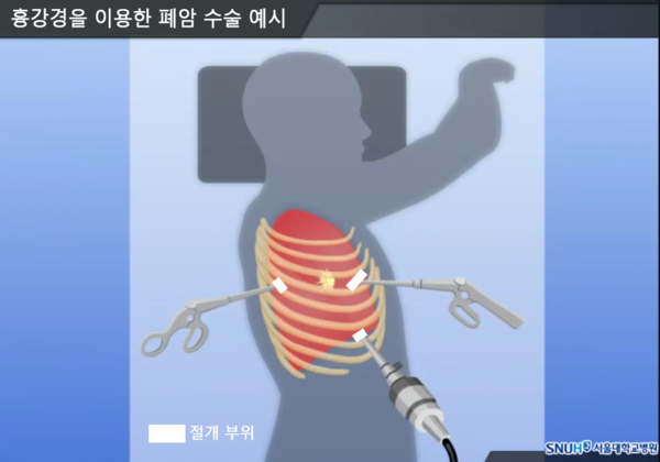 그래픽 제공=서울대병원