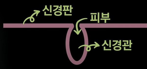 딤플 혈성 과정. 이미지 캡쳐=​서울대병원tv