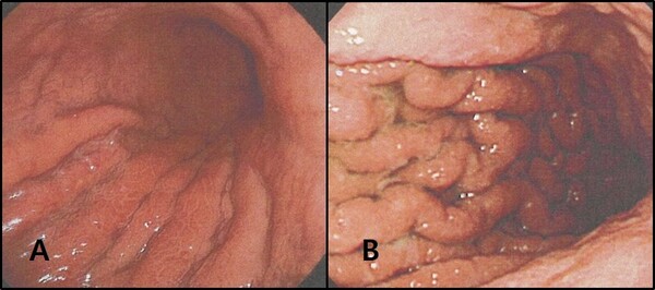 A: 4형 위암, B: 비후성 위염. 내시경검사로는 구분이 매우 힘든 경우로 조직검사에서 암이 나오지 않았더라도 추적관찰이 절대적으로 필요하다. 이미지 출처=서울성모병원 