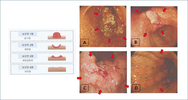 A: 1형, B: 2형, C: 3형, D:4형 위암. 다른 형태의 암과 달리 덩어리나 궤양을 만들지 않는 특징적인 소견을 보인다. 그래픽 출처=서울성모병원