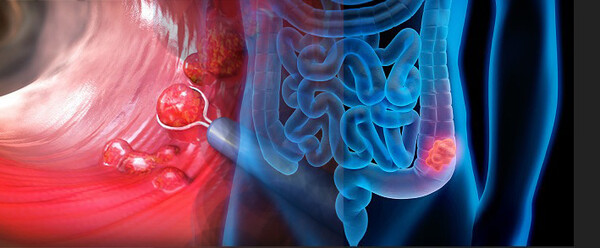대장암 이미지. 이미지 출처=게티이미지