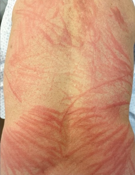 표고버섯 피부염. 이미지 출처='나는 의사다' 캡쳐