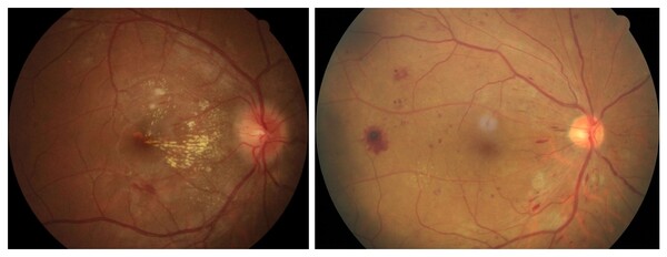 (좌) 고혈압망막병증 환자의 안저사진, (우) 당뇨망막병증 환자의 안저사진 (출처 김안과병원)